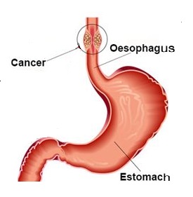 Oesophagus Cancer and its treatment