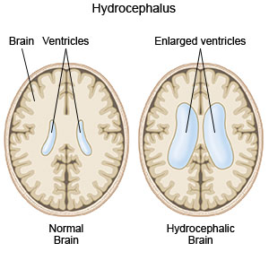 Hydrocephalus and Homoeopathy