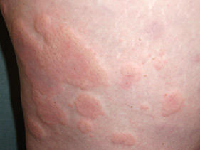 Urticaria, Hives. Allergy, Angioedema