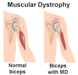 Muscular-dystrophy-in-biceps