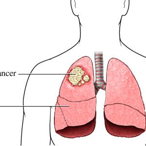 Lungs and Bronchial Cancer