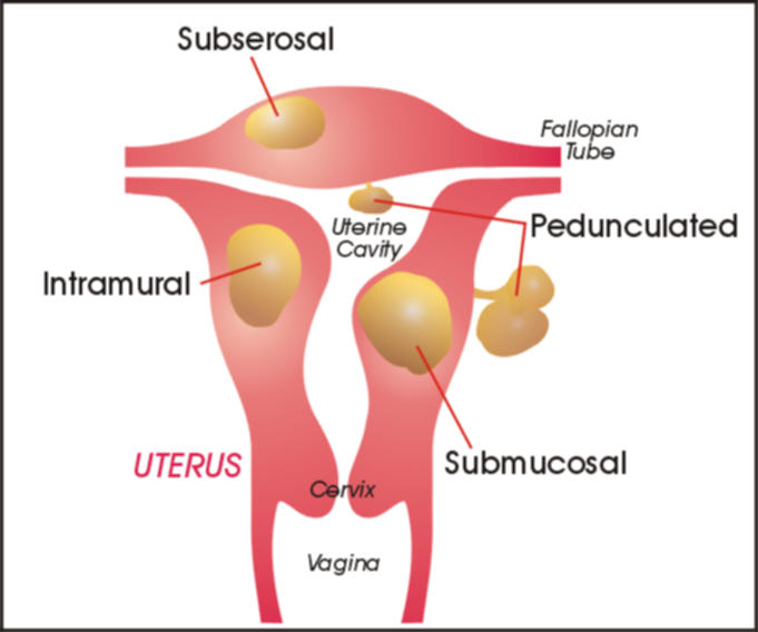 Uterine Fibroids, Fibroid  Uterus