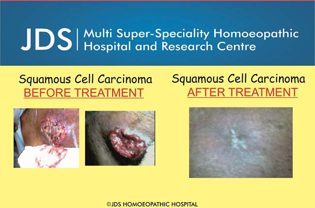 Sqamous cell carcinoma-f